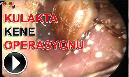 KULAKTA KENE OPERASYONU